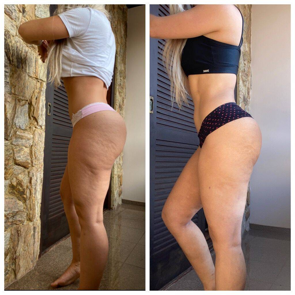 Resultado antes e depois do tratamento